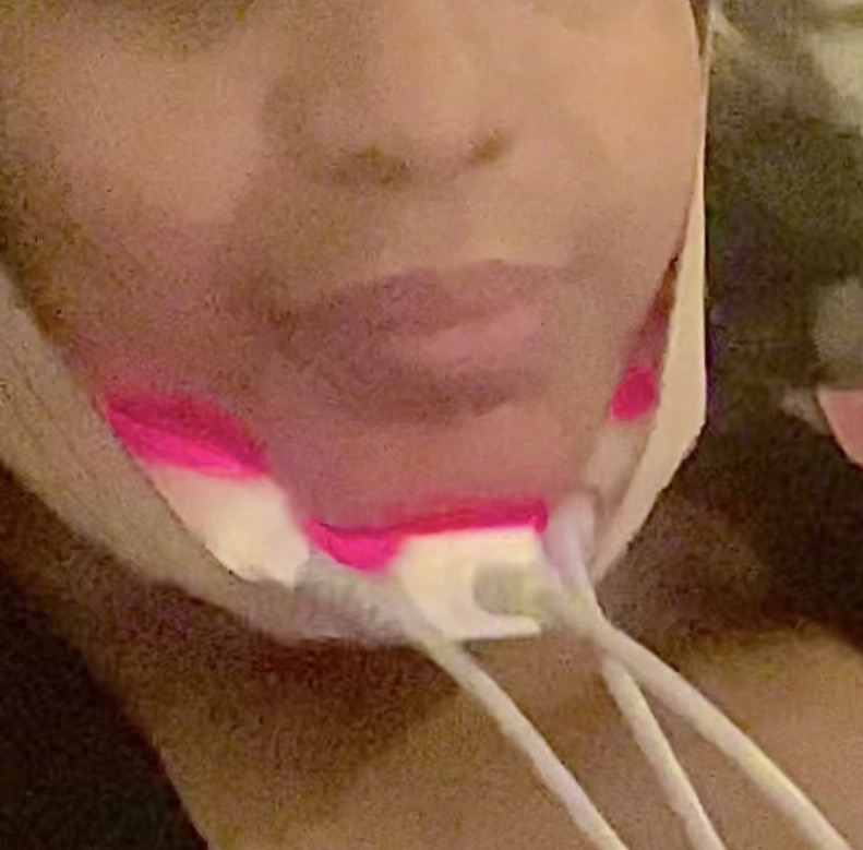 Light✧Sculpt✨ Laser Lipo
