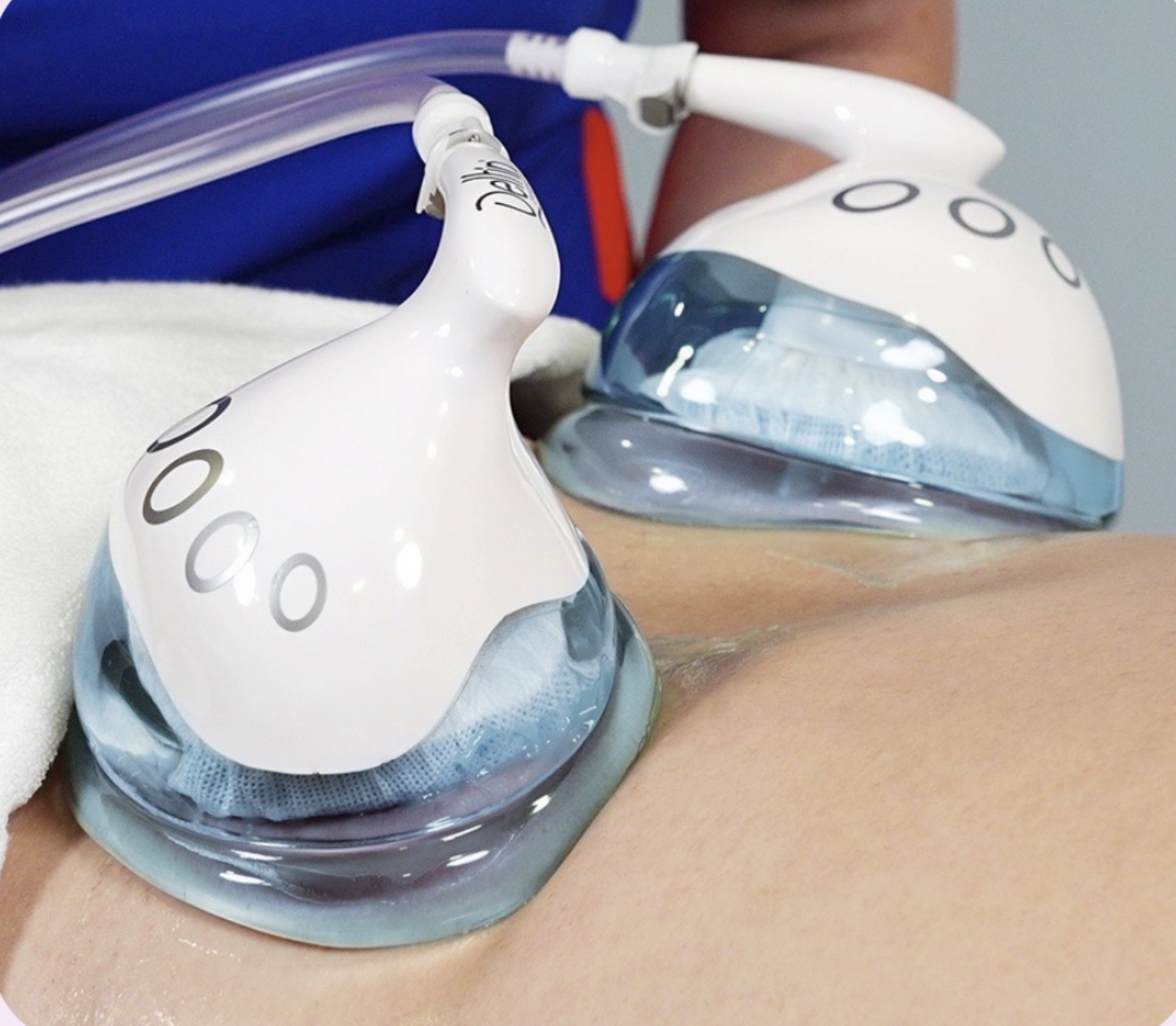 Cold✧Sculpt✨ Cryolipolysis Fat Freezing