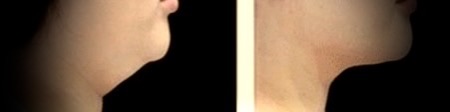Chin Profile Comparison