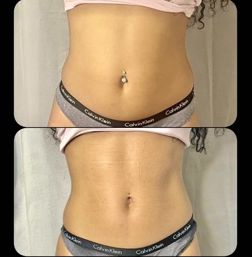 Abdomen โ Client Photo Comparison 7