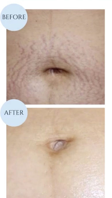 Stretch Mark Appearance Comparison