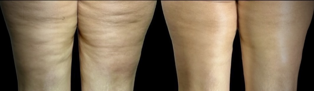 Thigh Appearance Comparison