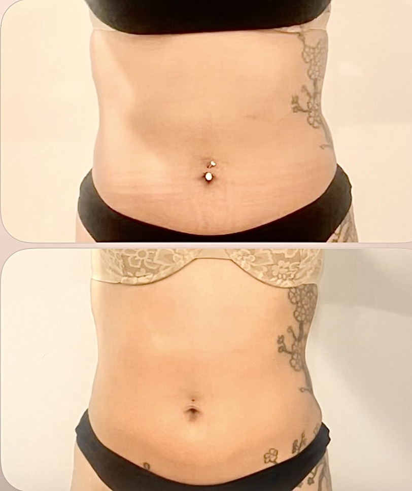 Abdomen โ Client Photo Comparison 3