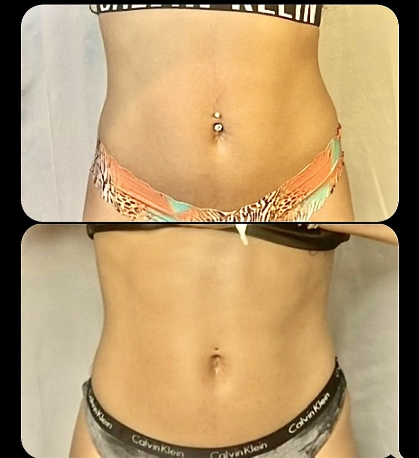 Abdomen โ Client Photo Comparison 11