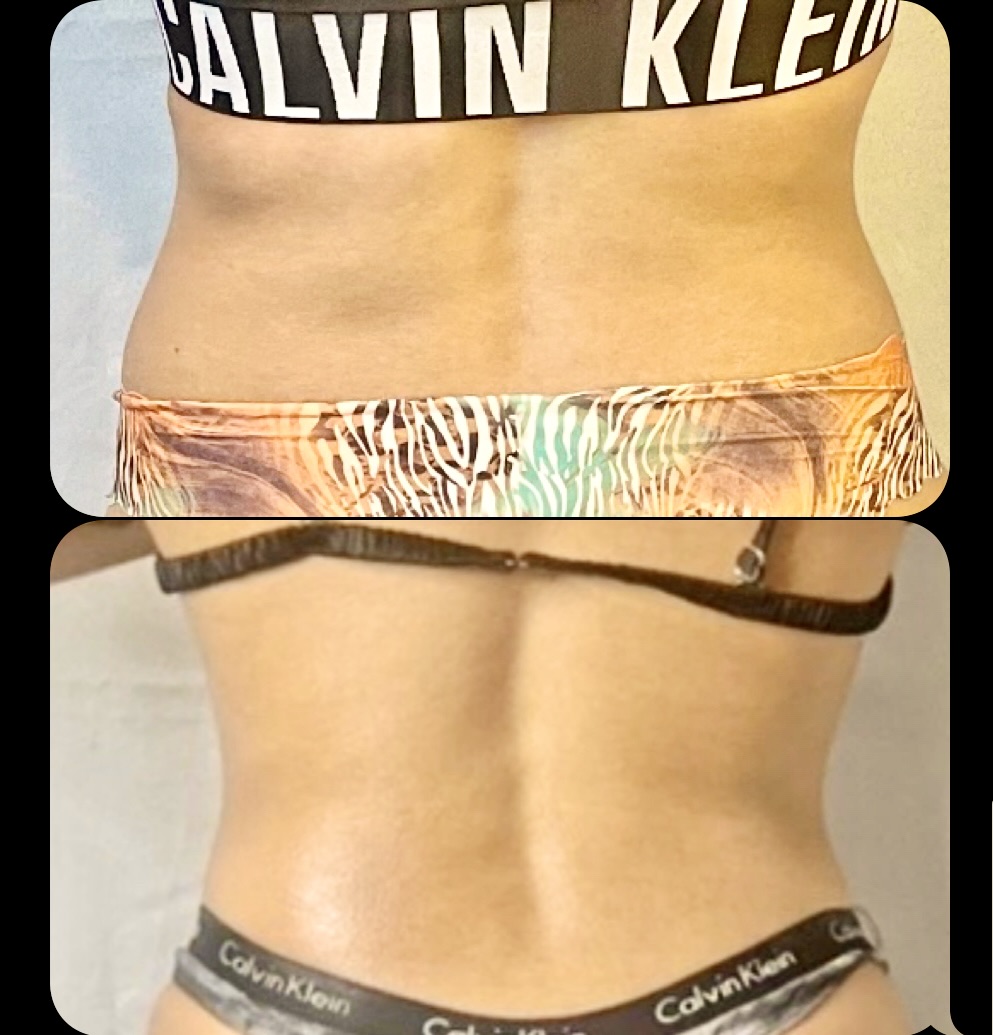 Abdomen โ Client Photo Comparison 8