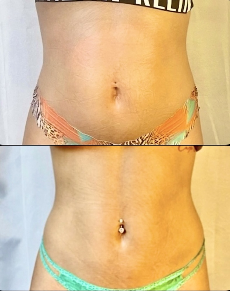 Abdomen โ Client Photo Comparison 1