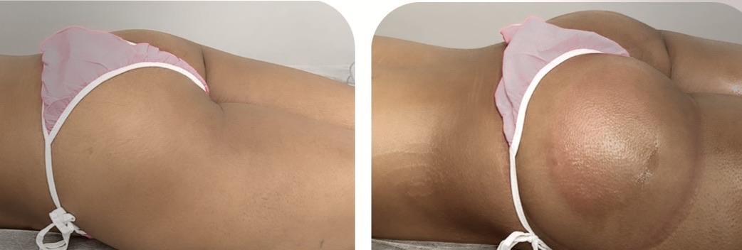Glute Contour Comparison