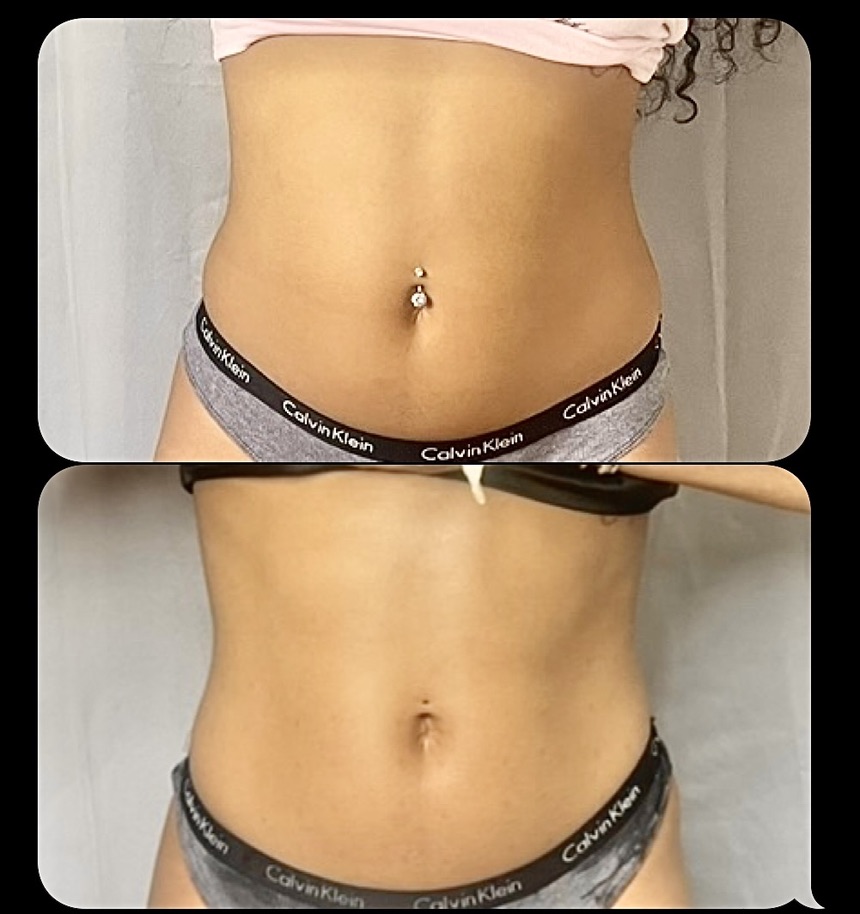 Abdomen โ Client Photo Comparison 10